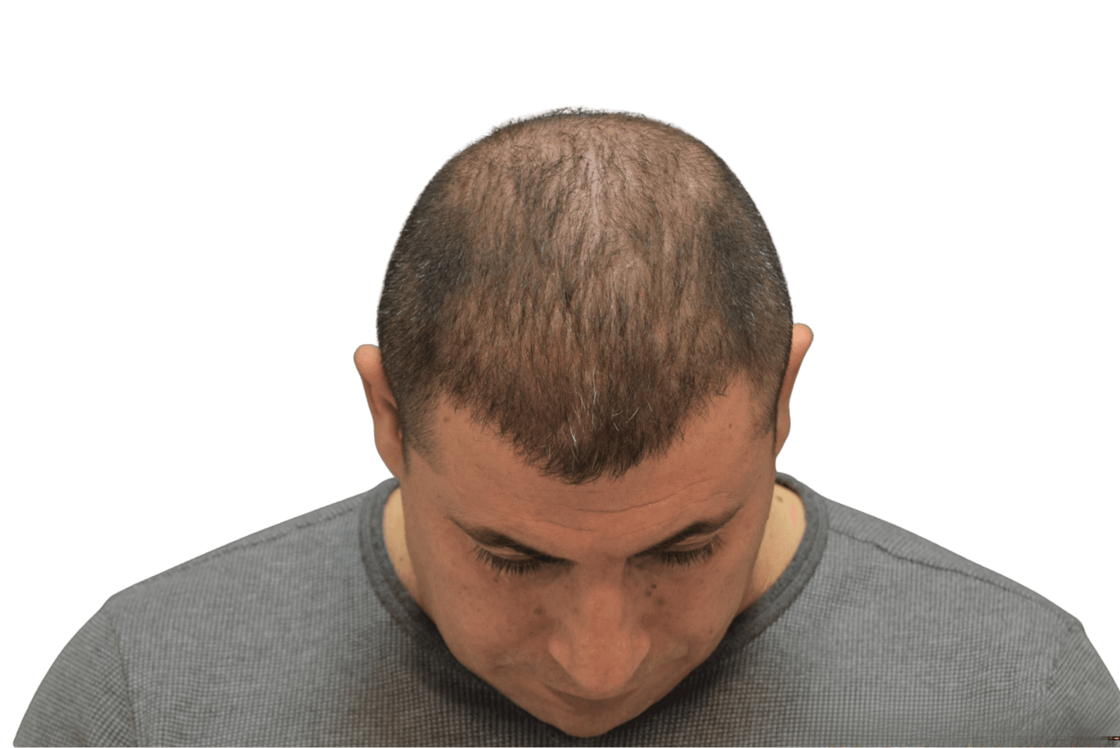 Six months after treatment with visibly stronger density across the crown and top of the scalp