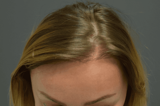 Six months after treatment showing improved female frontal framing and denser coverage at the front