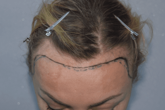 Before treatment female frontal view with the planned hairline marked for restoration