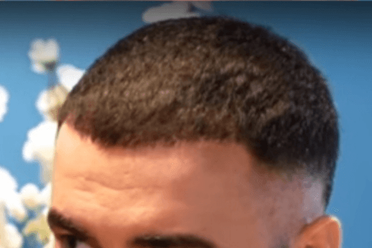 Six months after frontal hairline treatment showing lower, fuller framing across the front hairline