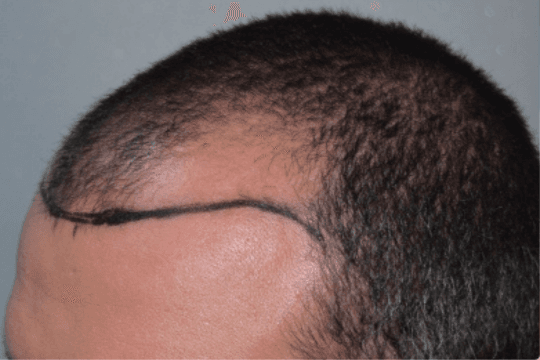 Before treatment view of a frontal hairline with marked recession and the planned hairline drawn for restoration
