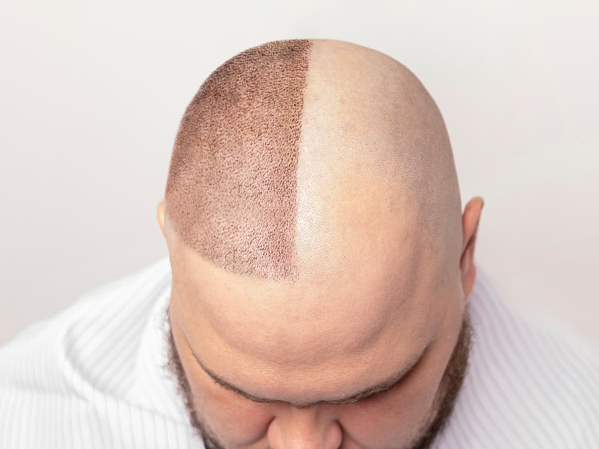 Close-up clinical image showing a scalp during an early hair transplant stage